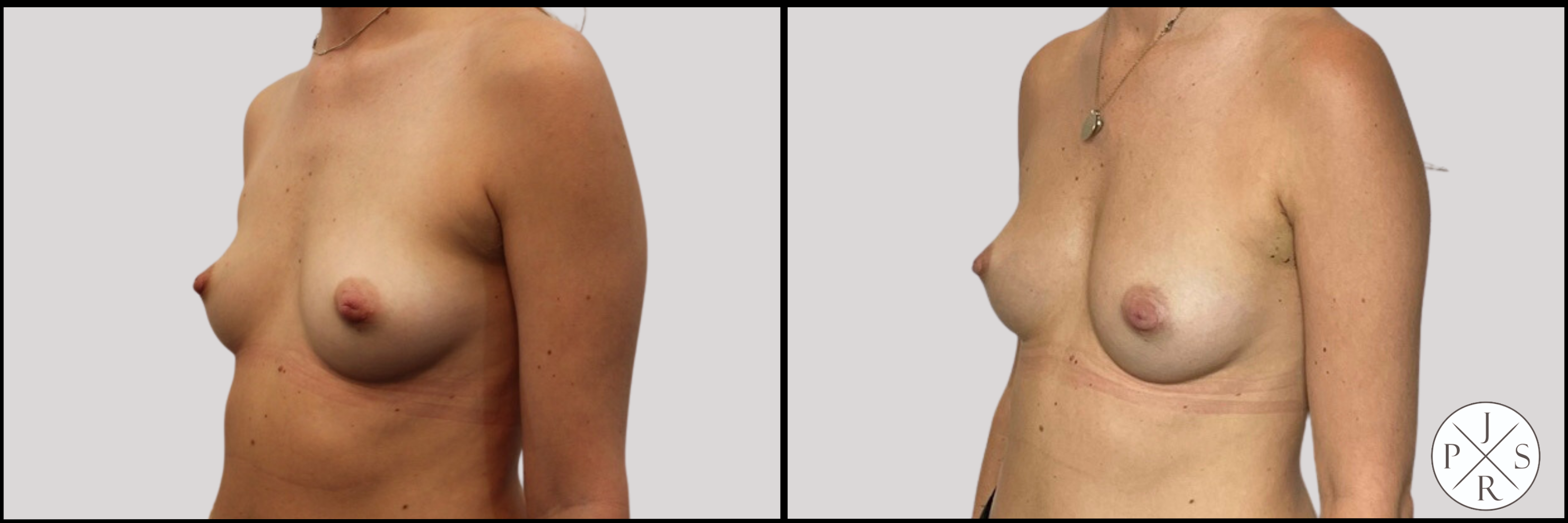 Fat Transfer Breast Augmentation Before & After Image